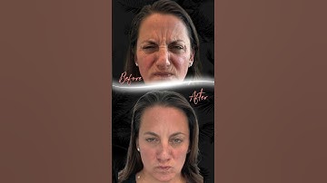 Botox vs. Fillers, When Do I Get Which?