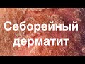 Себорейный дерматит