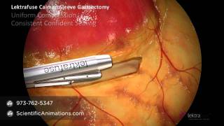 Gastric Sleeve Surgery - Medical Animation