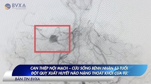 CAN THIỆP NỘI MẠCH – CỨU SỐNG BỆNH NHÂN 53 TUỔI ĐỘT QUỴ XUẤT HUYẾT NÃO NẶNG THOÁT KHỎI CỬA TỬ