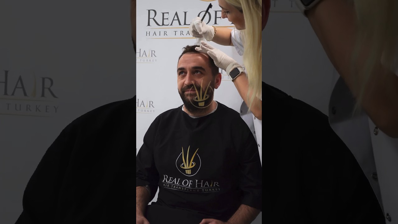 Hair Transplant journey | Real Of Hair 