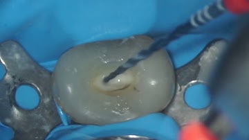 VDW Dental · Grande & Plotino: RECIPROC blue - Step by step preparation (clinical video)