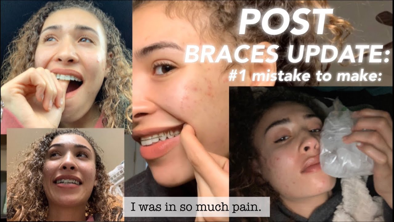 Post Braces Update I MADE THE WORST MISTAKE YouTube