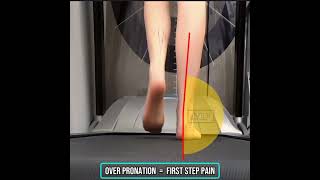 Relieve First-Step Pain with Orthotics for Over Pronation | Heel Pain Relief Tips
