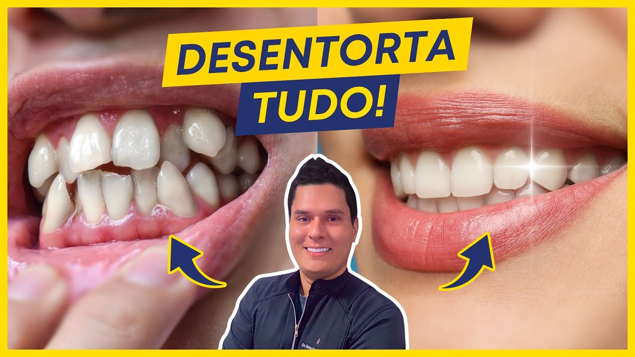 Dentes Tortos: Como Corrigir? (Os 2 principais métodos)
