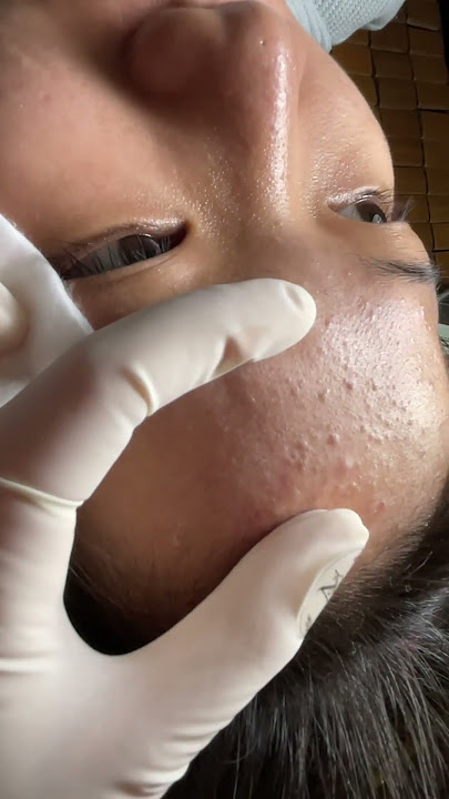 Download lagu #acnetreatment #acnetherapy #acne #antiacne