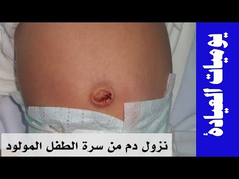 فيديو: هل ينزف الحبل السري عند السقوط؟