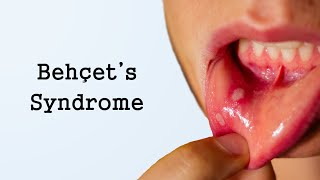 Behcets Syndrome