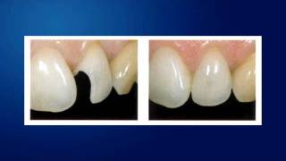 Carrollton Dentist And The Truth About Amalgams