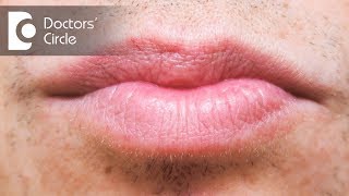 Treatment options for white spots in lips - Dr. Rasya Dixit