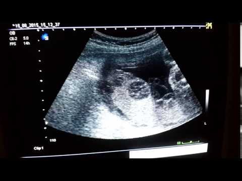 Vídeo: La placenta fa soroll?