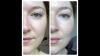 I used Volufiline for 30 days and here are the results | Before & After Photos