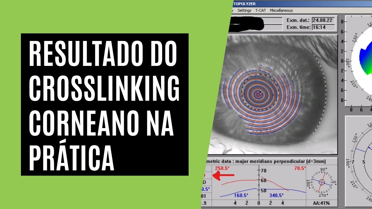 Resultado do Crosslinking Corneano na Prática