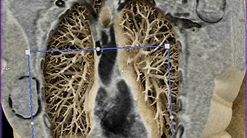 Pulmonary Vasculature with Cinematic Rendering