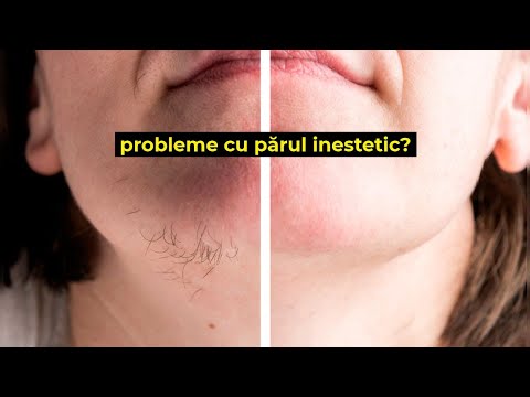 Epilare definitiva cu