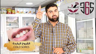 قروح البرد || Cold sores || قروح الفم -- اسباب وعلاج