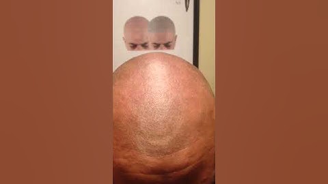 Scalp Micropigmentation 3d style w/ Chris Mr. Natural HeadStrongNY