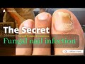 Fungus On Toenails Treatment! Highly Effective Home Remedies for Toenail Fungus! toenail fungus cure