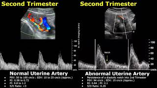 Uterine Artery Spectral Doppler Ultrasound Normal Vs Abnormal Images | Pregnant/Nongravid Uterus USG