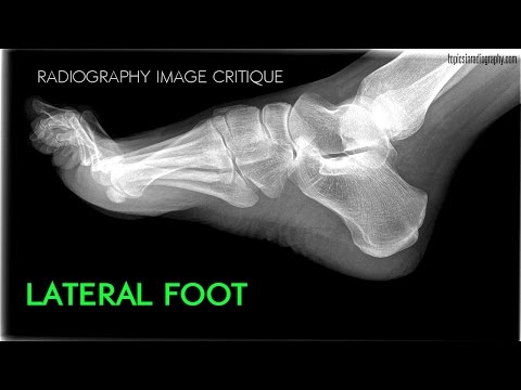Video: Wat is elongatie bij radiografie?