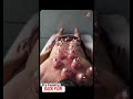 Dry Cupping Therapy for Back Pain Relief | Natural Pain Treatment