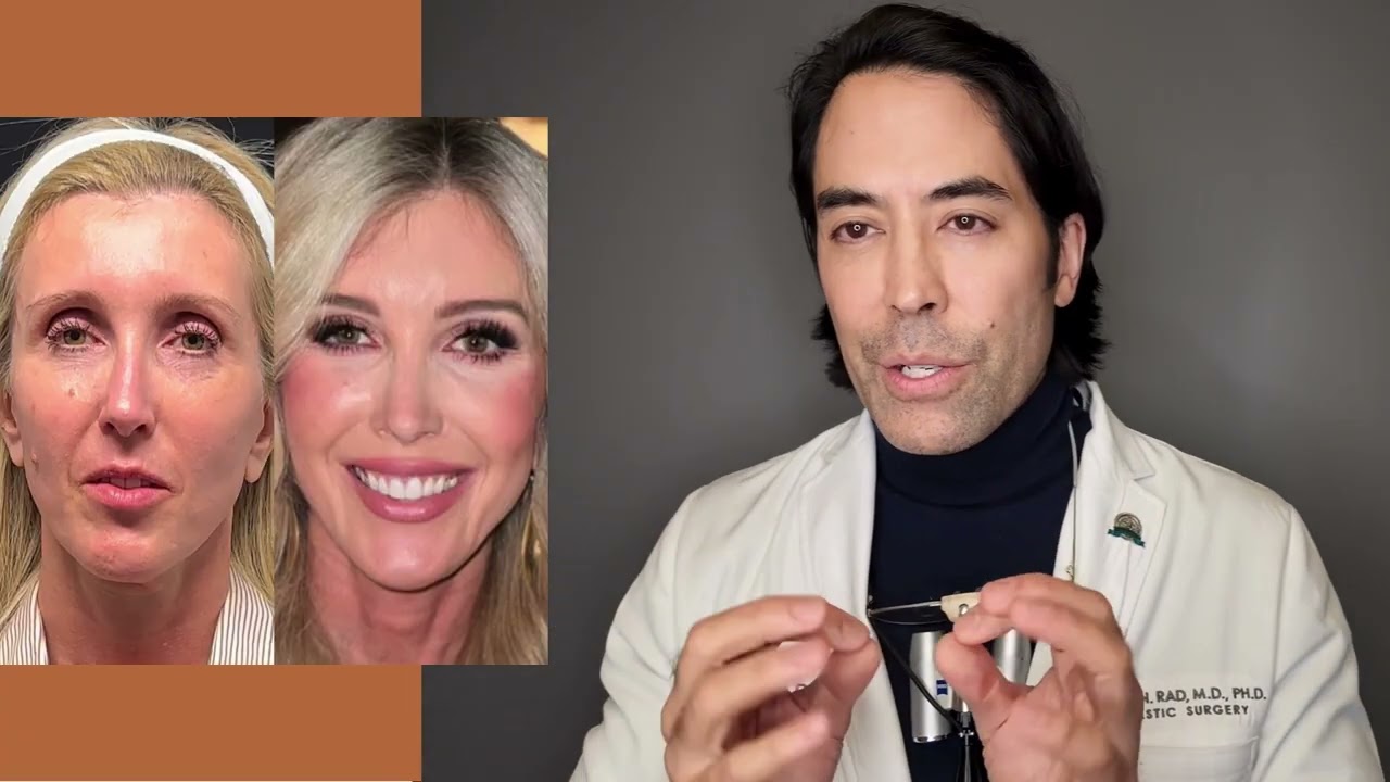 ENDOSCOPIC 'PONYTAIL' FACELIFT