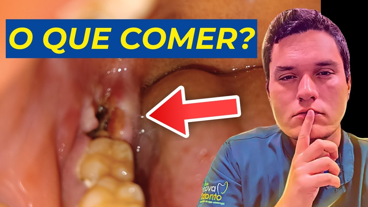 O QUE COMER após EXTRAIR um DENTE? (Guia Completo) - YouTube
