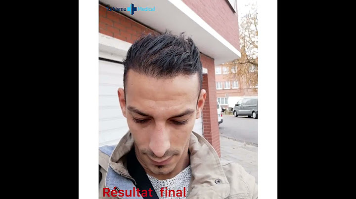 Greffe de cheveux Turquie résultat avant après 12 mois? | Turkisme Medical