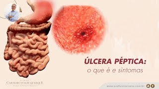 Úlcera péptica: o que é e sintomas | Prof. Dr. Luiz Carneiro CRM 22.761