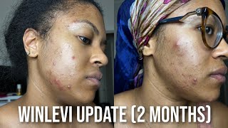 Winlevi Update/Experience (2 Months) [Before & After Acne Pics] + mini vlog w/ updates