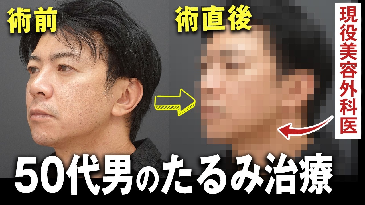 【必見】最新の高周波（RF）治療ボルニューマを美容外科医が体験【水の森美容クリニック】