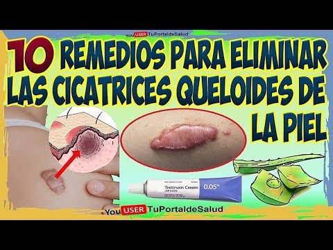 10 Remedios Caseros para Eliminar Queloides - Como Eliminar la Cicatrices Queloides