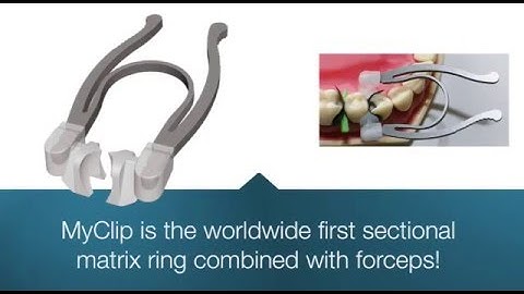 MyClip   The  first sectional matrix ring combined with forceps!