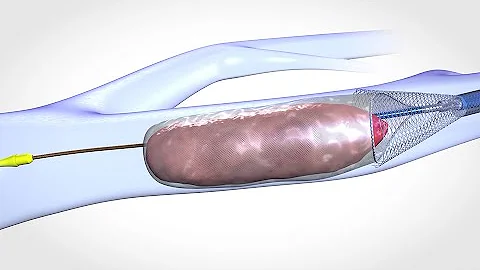 Blood Clot Removal Device - Medical & Scientific Video Production
