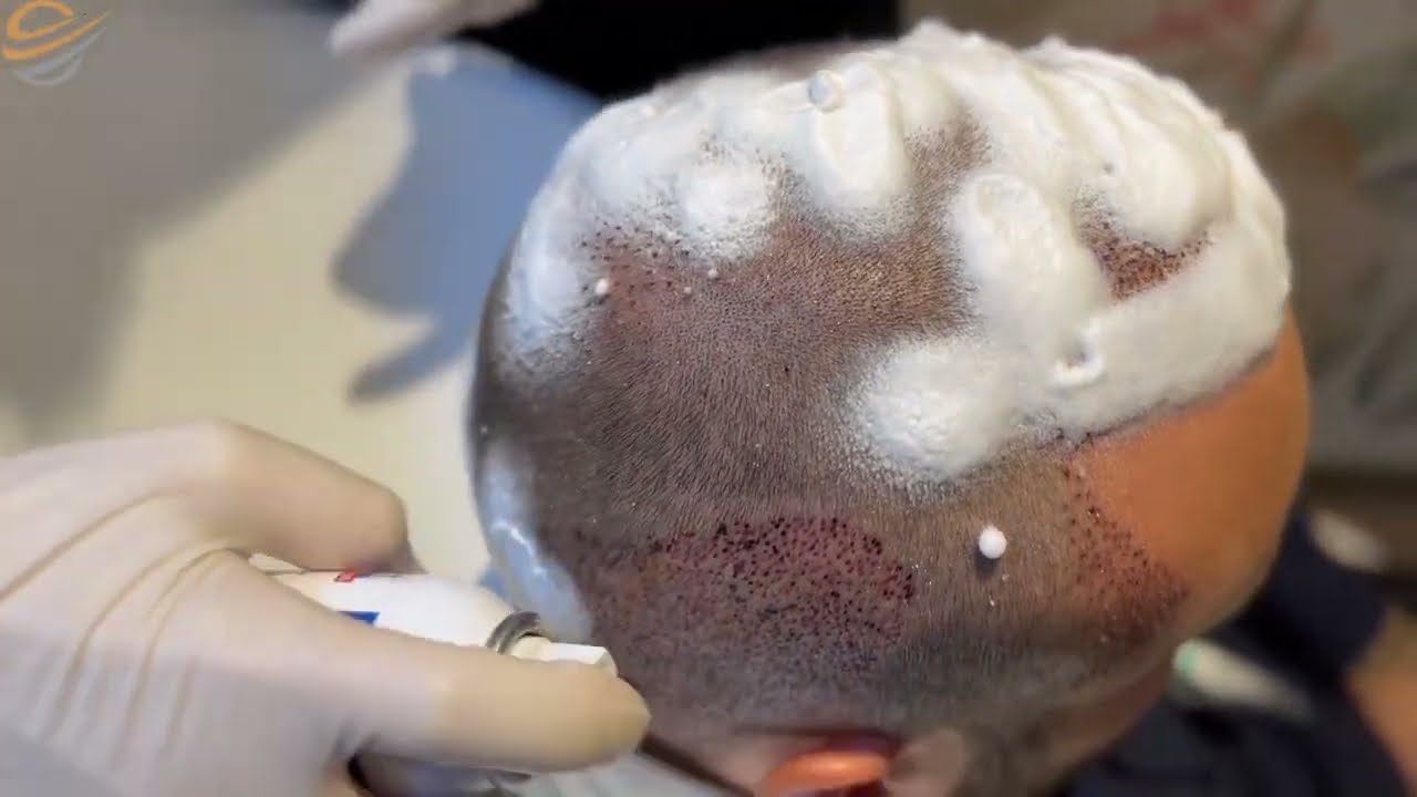 Proces pranja kose nakon transplantacije od 4.og do 10.og dana