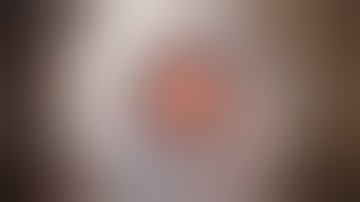 DMEK Triple Technique (combined cataract and DMEK surgery)