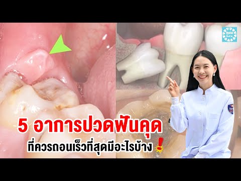 5 อาการฟันคุดที่ควรถอนฟันเร็วที่สุดมีอะไรบ้าง!!