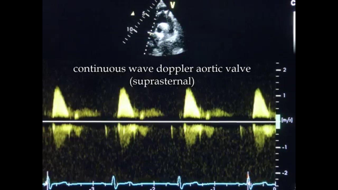 Continuouswave Doppler YouTube