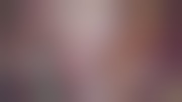 Laparoscopic nephrectomy for a non funcioning ectopic pelvic kidney