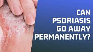 Can Psoriasis Go Away Permanently? What Helps Psoriatic Arthritis In The Hands?