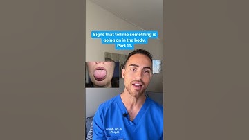 Causes Of Bumps On The Side Of The Tongue? #sleepapnea #tongue #snoring