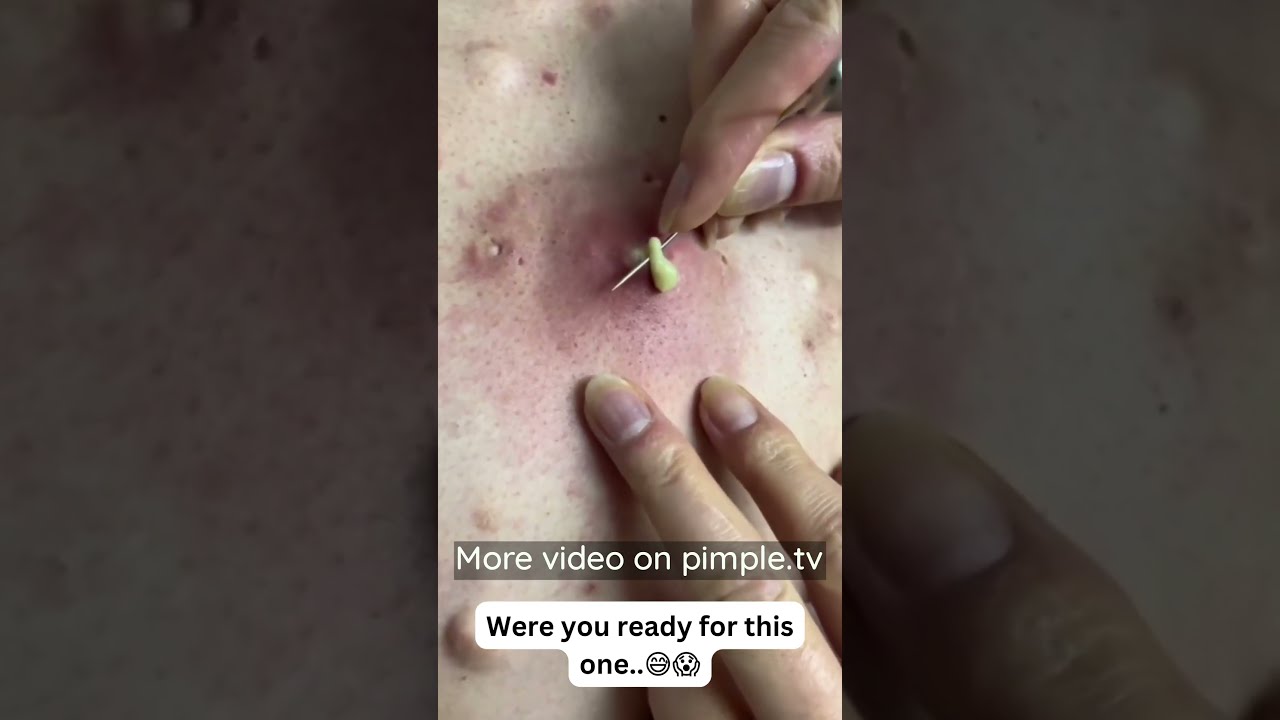 Never Squeeze Acne With Your Hands 