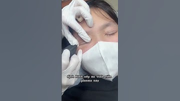 Định hình nếp mí vĩnh viễn bằng Plasma này mọi người đã biết chưa? #plasma