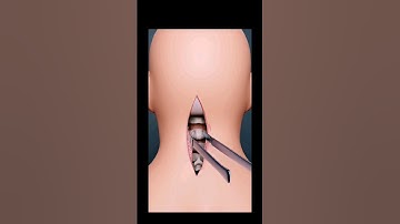 How Brain Clot Is Removed? (3D Animation) #shorts