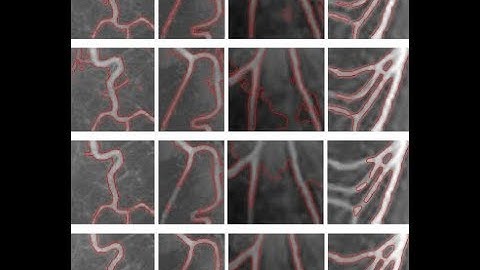 A robust active contour segmentation | Projects At Bangalore | Projects In Bangalore