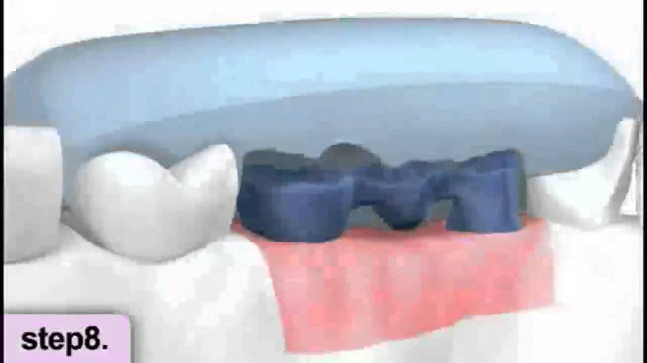 Dental Implants Cape Town YouTube