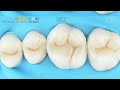 Replicate easily the occlusal anatomy  lm arte posterior replica 