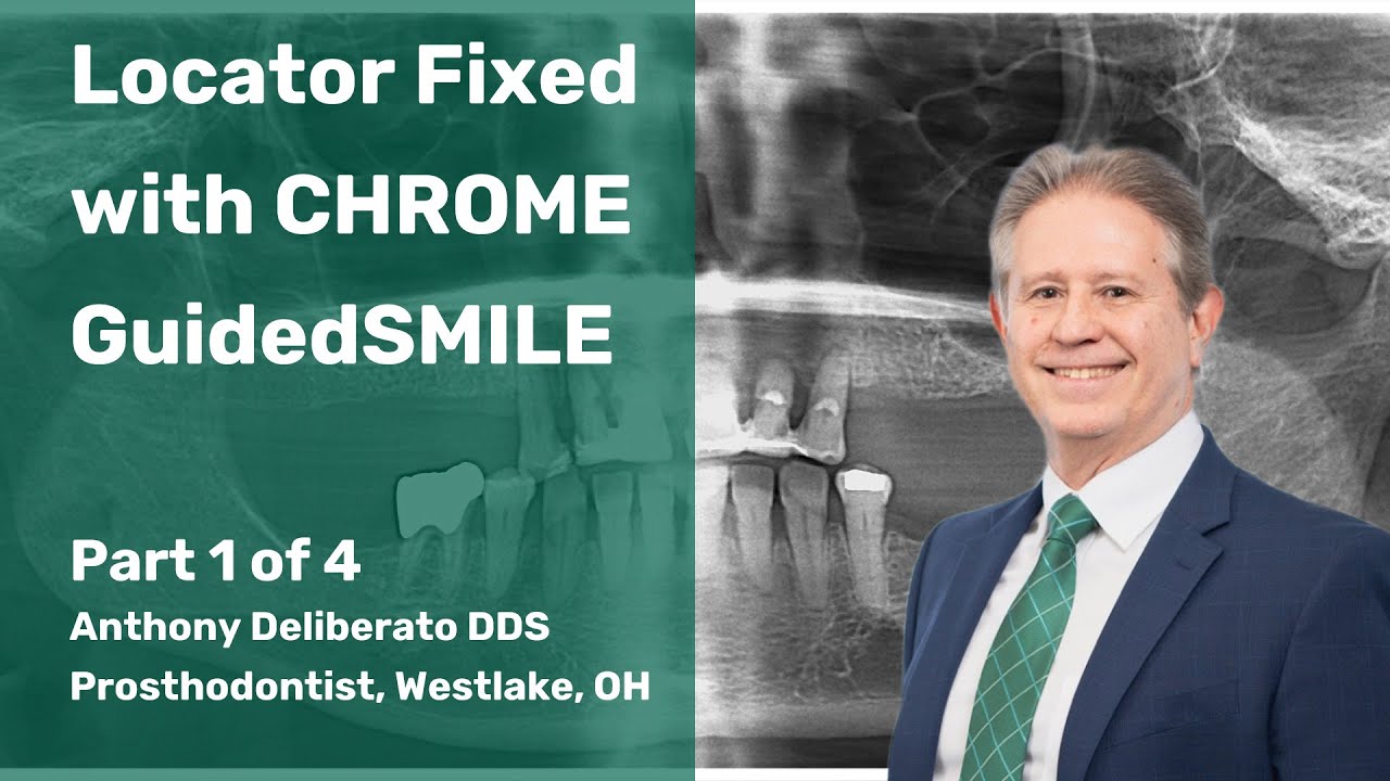 Locator Fixed with CHROME GuidedSMILE part 1 of 4