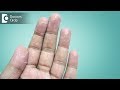 Ways to manage peeling of skin from hands - Dr. Sudheendra Udbalker