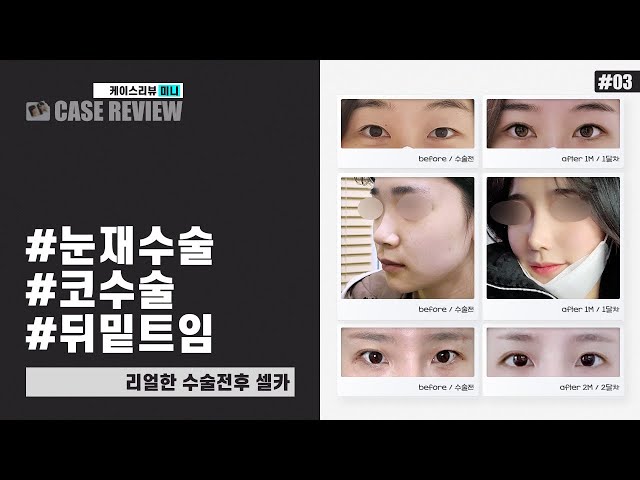 [케이스리뷰 미니] 수술 전후 + 100% 리얼 후기  #눈재수술 #코수술 #뒤밑트임